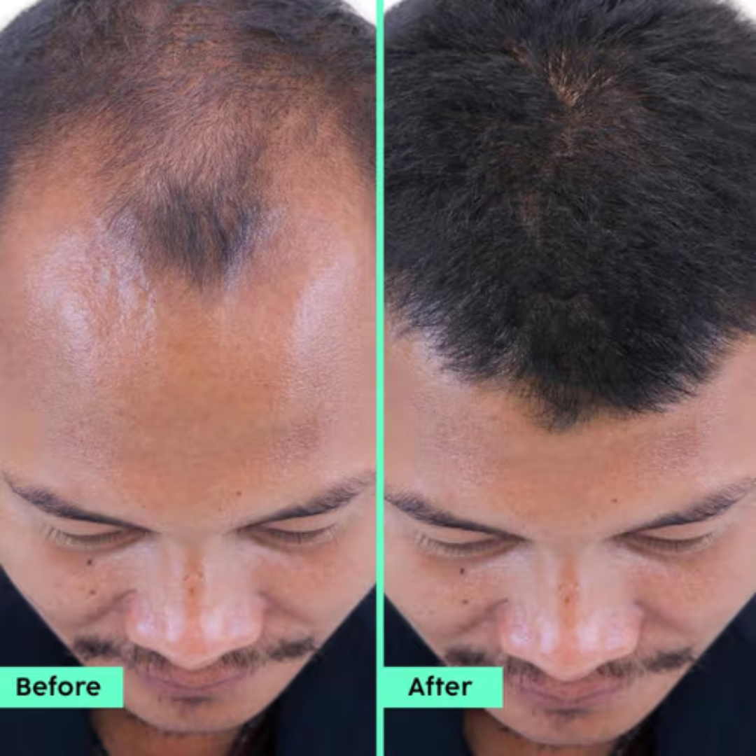 Plix Rosemary Hair Growth Advanced Hair Spray | Redensyl + Aquaxyl + Rosemary Oil | Reduces Hair Fall, Boosts Growth & Strengthens Roots