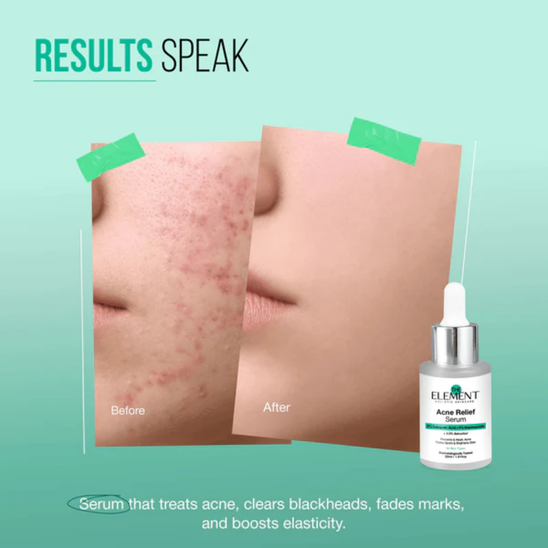 The Element Acne Relief Serum – Clear Acne, Control Oil & Reveal Clearer Skin – Triple Action Acne Defense – Fights Acne, Controls Oil, Minimizes Pores, Fades Marks