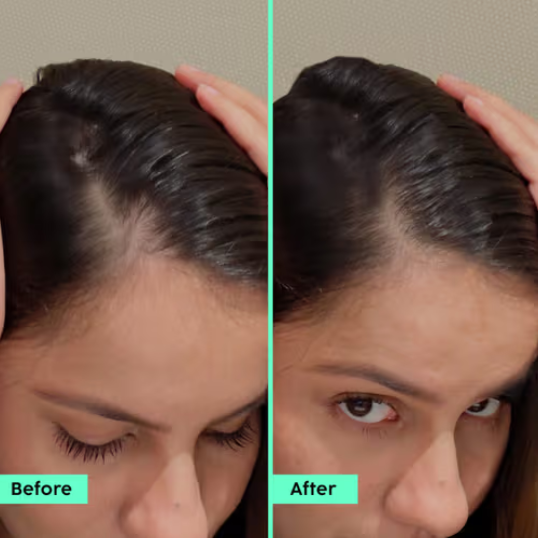 Plix Rosemary Hair Growth Advanced Hair Spray | Redensyl + Aquaxyl + Rosemary Oil | Reduces Hair Fall, Boosts Growth & Strengthens Roots