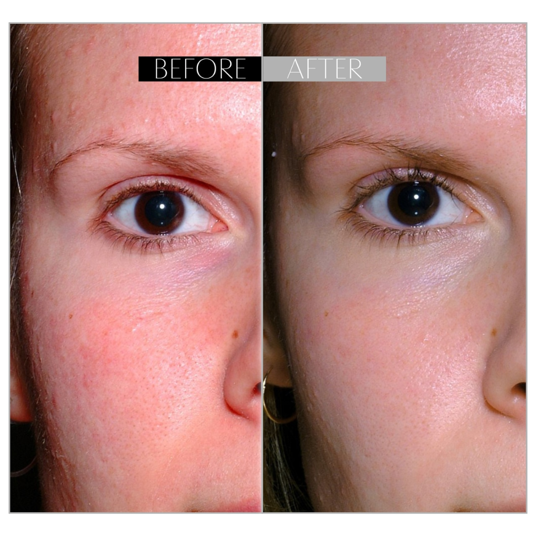 Axis-y Pore Clarifying & Acne treatment Mask | Gently clean pores & remove ance | bright & clean skin