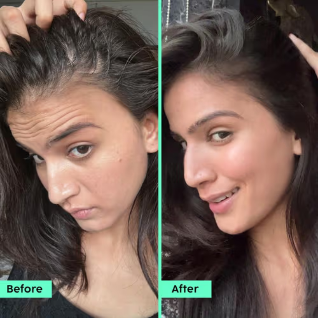 Plix Rosemary Hair Growth Advanced Hair Spray | Redensyl + Aquaxyl + Rosemary Oil | Reduces Hair Fall, Boosts Growth & Strengthens Roots