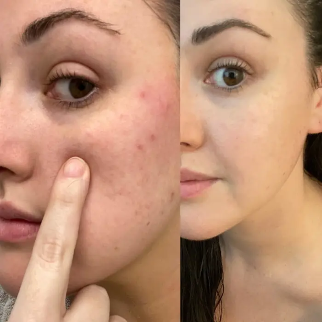 Axis-y Pore Clarifying & Acne treatment Mask | Gently clean pores & remove ance | bright & clean skin