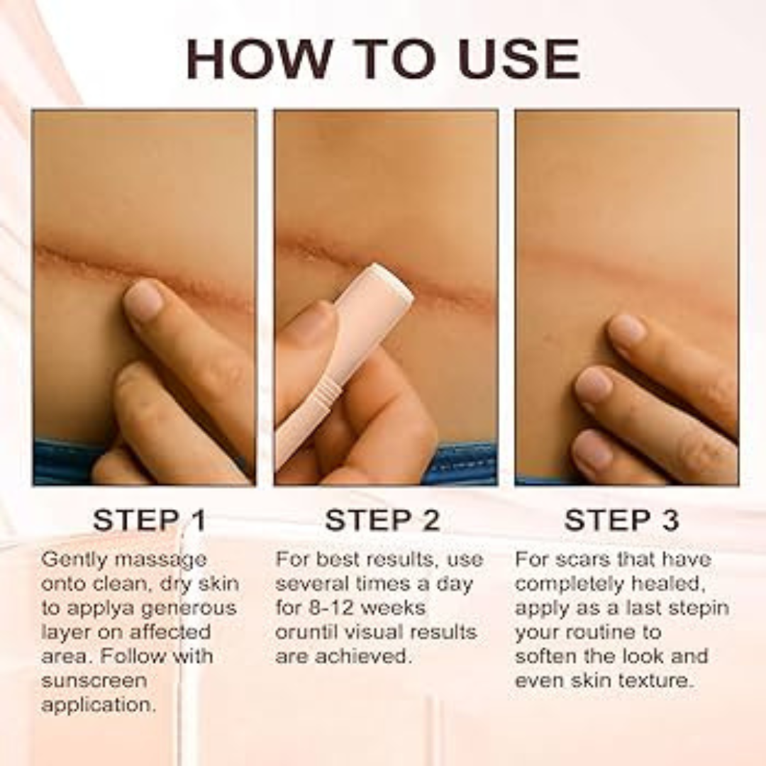 Prequel Scar Solutions Silicone Scar Stick | 60% Silicone + Onion Bulb Ferment + Centella Asiatica | Reduces Scar Thickness, Redness & Improves Texture