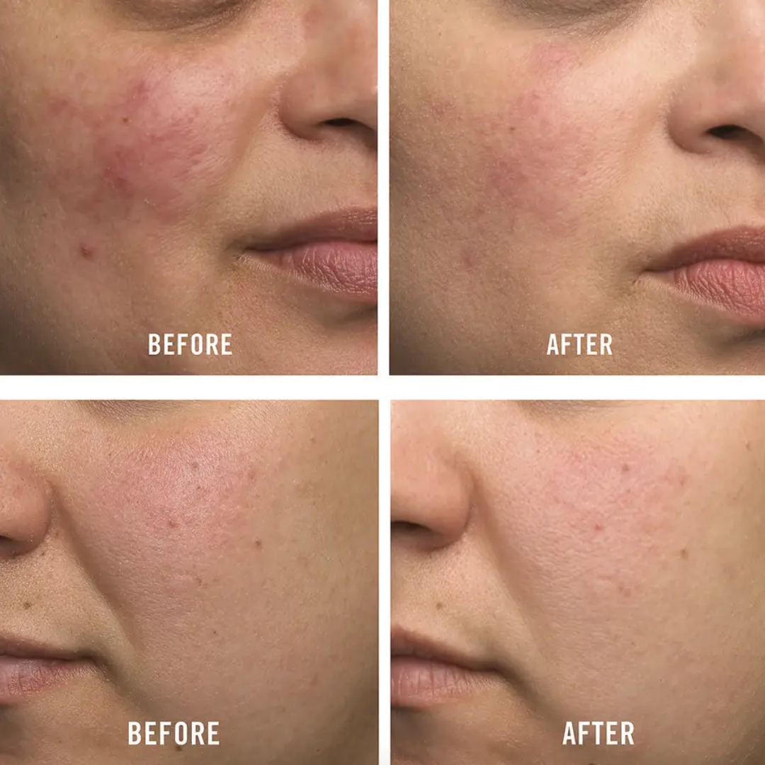 Axis-y Pore Clarifying & Acne treatment Mask | Gently clean pores & remove ance | bright & clean skin