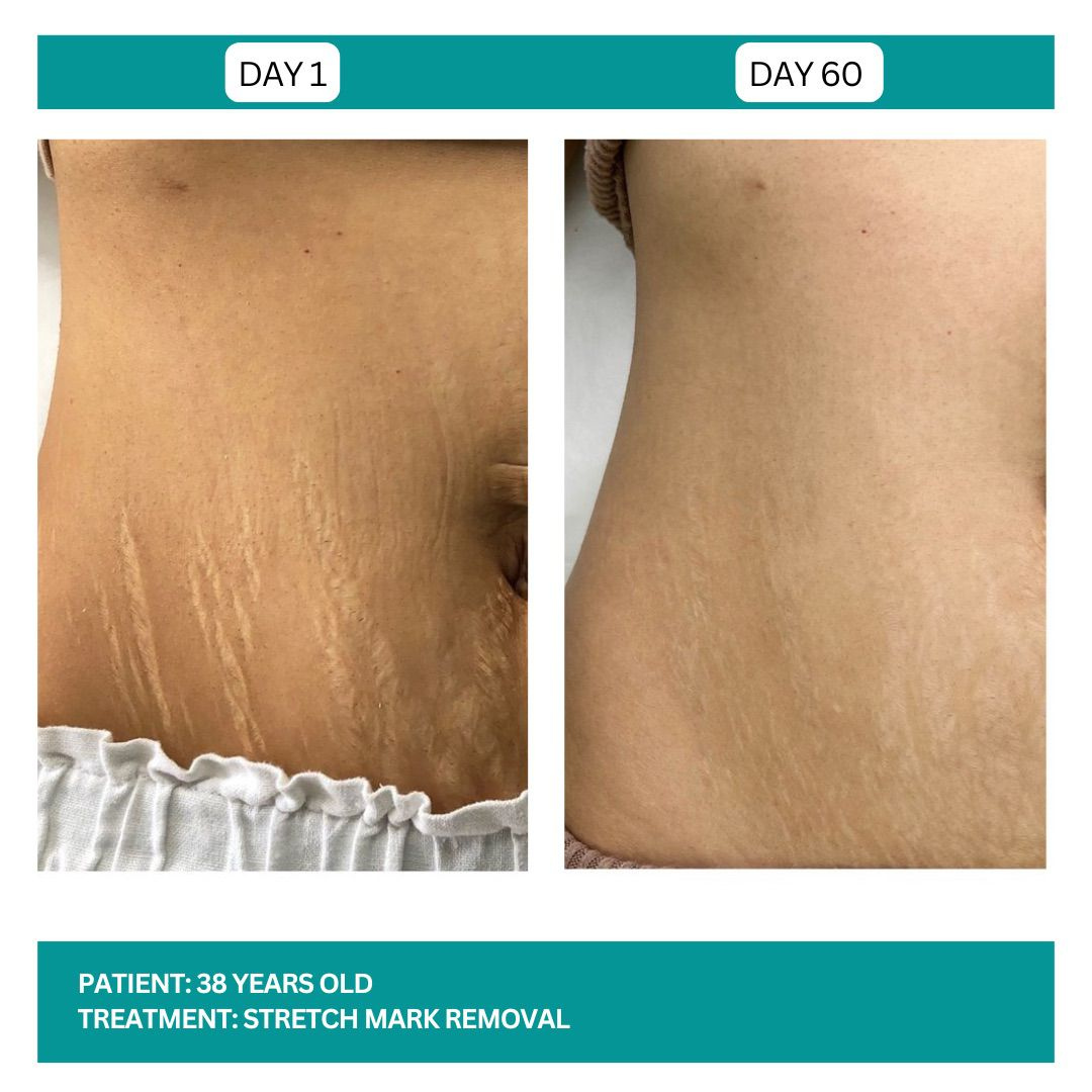 Ciara Stretchmarks Treatment Oil – Fade Stretchmarks on Belly & Thighs – With Fish Collagen – Nourish, Repair & Renew – Deeply Hydrates, Improves Elasticity – Safe for Sensitive Skin