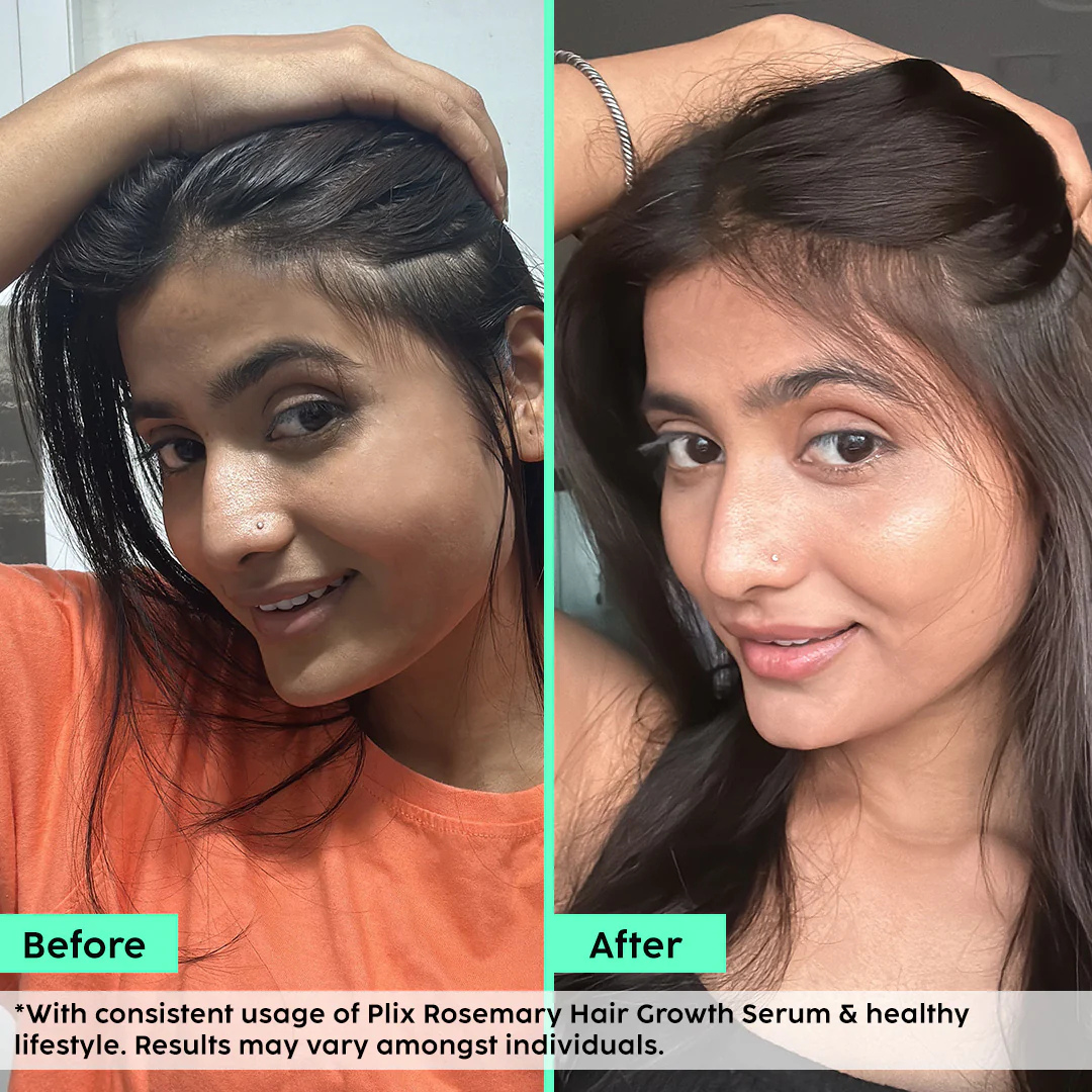Plix Rosemary Hair Growth Advanced Hair Spray | Redensyl + Aquaxyl + Rosemary Oil | Reduces Hair Fall, Boosts Growth & Strengthens Roots
