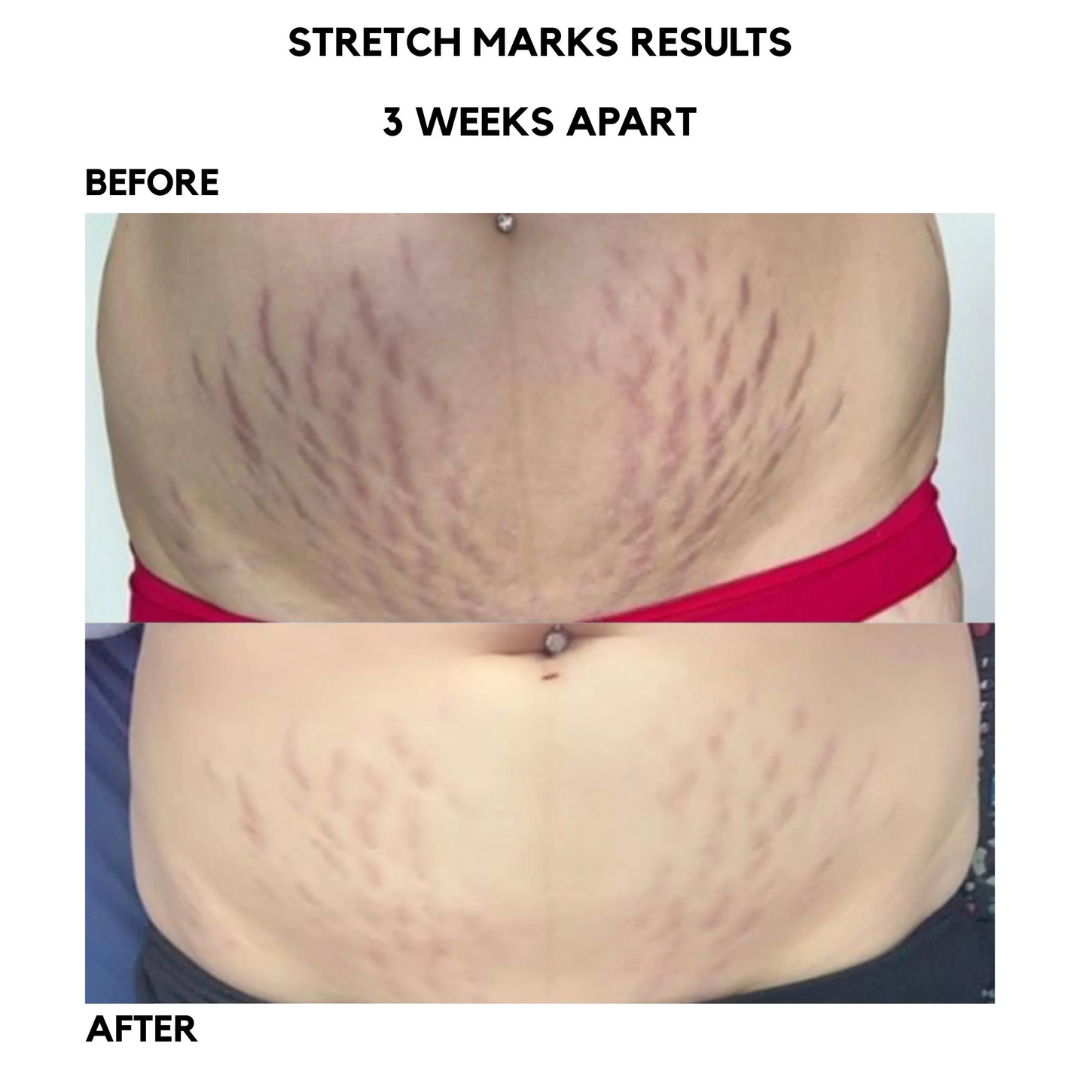 Ciara Stretchmarks Treatment Oil – Fade Stretchmarks on Belly & Thighs – With Fish Collagen – Nourish, Repair & Renew – Deeply Hydrates, Improves Elasticity – Safe for Sensitive Skin