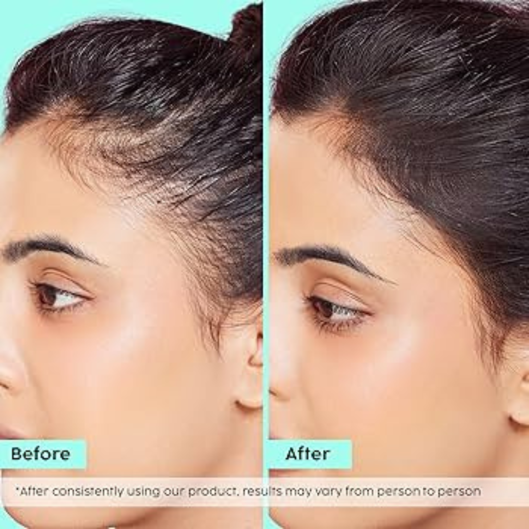 Plix Rosemary Hair Growth Advanced Hair Spray | Redensyl + Aquaxyl + Rosemary Oil | Reduces Hair Fall, Boosts Growth & Strengthens Roots