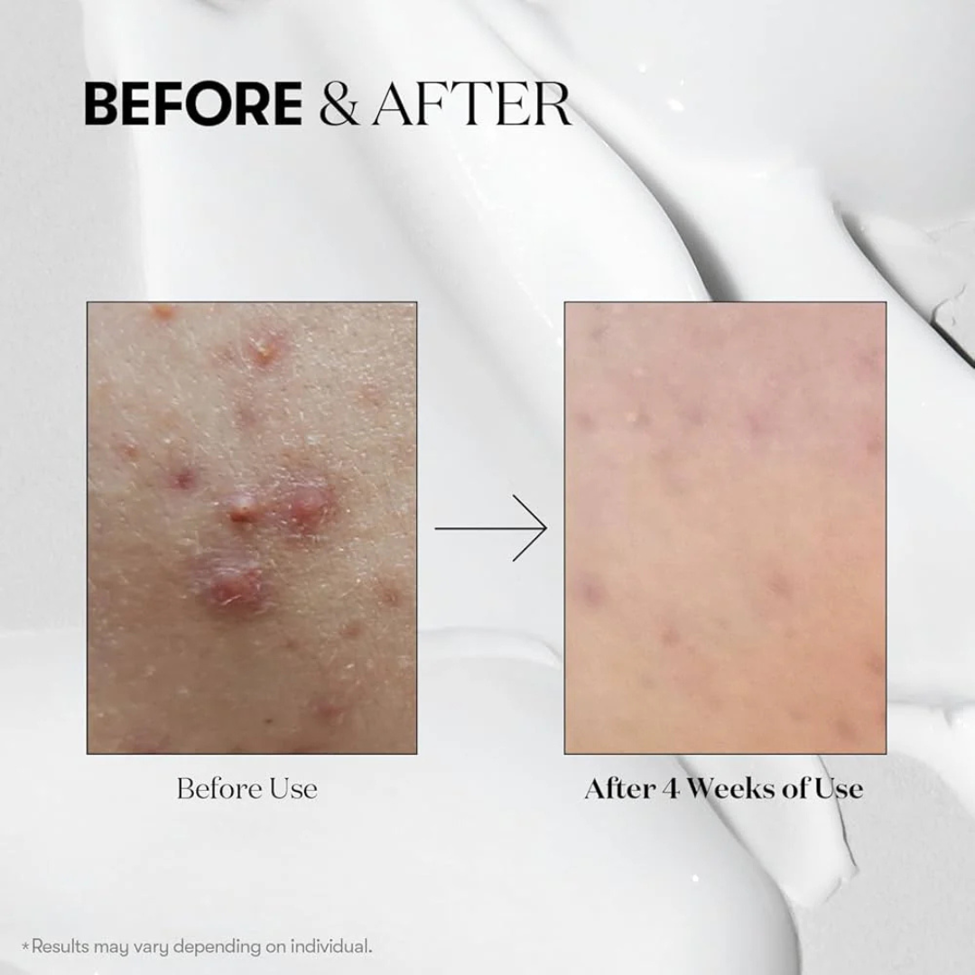 VT Cosmetics Cica Reedle Shot 100 | Micro-Needling Serum with 95,000 Cica Reedles | Smooths Texture, Boosts Absorption & Repairs Skin Barrier