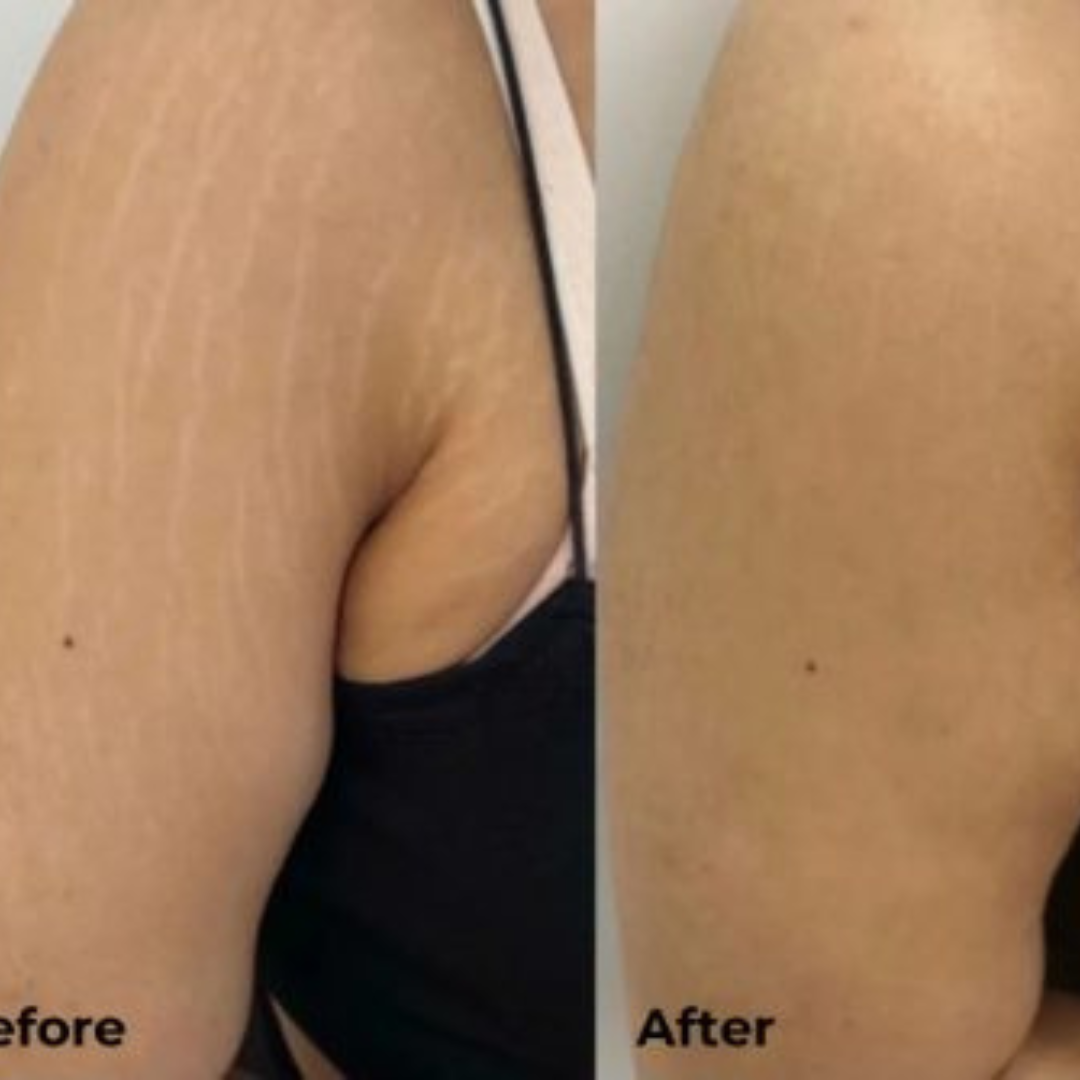 Ciara Stretchmarks Treatment Oil – Fade Stretchmarks on Belly & Thighs – With Fish Collagen – Nourish, Repair & Renew – Deeply Hydrates, Improves Elasticity – Safe for Sensitive Skin