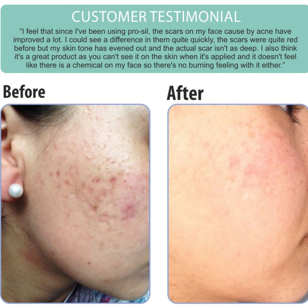 Prequel Scar Solutions Silicone Scar Stick | 60% Silicone + Onion Bulb Ferment + Centella Asiatica | Reduces Scar Thickness, Redness & Improves Texture