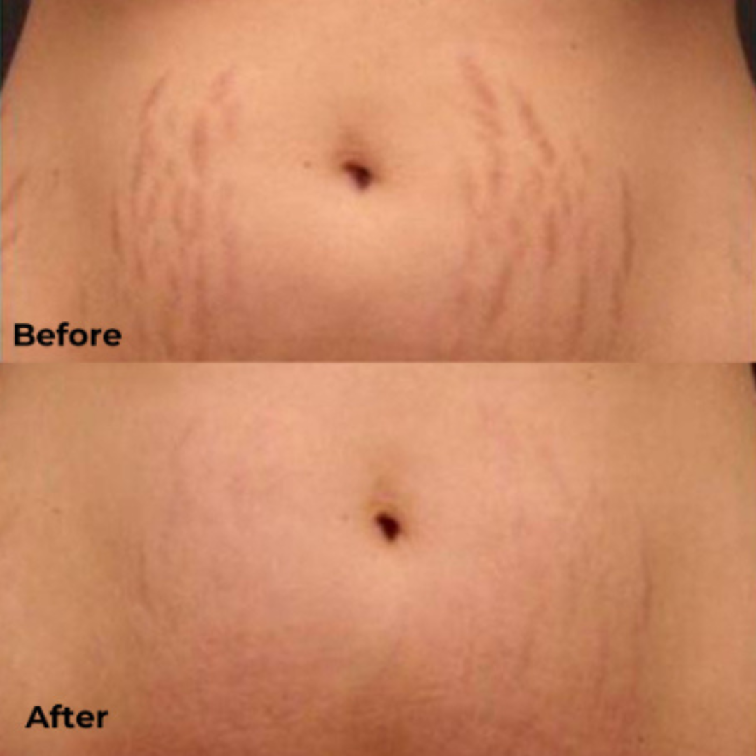 Ciara Stretchmarks Treatment Oil – Fade Stretchmarks on Belly & Thighs – With Fish Collagen – Nourish, Repair & Renew – Deeply Hydrates, Improves Elasticity – Safe for Sensitive Skin