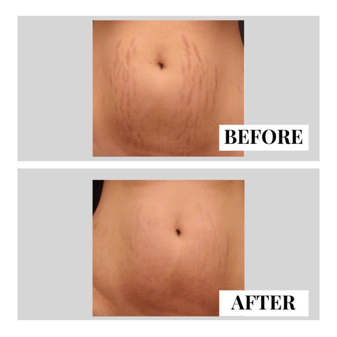 Ciara Stretchmarks Treatment Oil – Fade Stretchmarks on Belly & Thighs – With Fish Collagen – Nourish, Repair & Renew – Deeply Hydrates, Improves Elasticity – Safe for Sensitive Skin