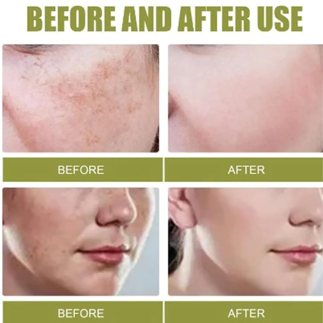 Axis-y Pore Clarifying & Acne treatment Mask | Gently clean pores & remove ance | bright & clean skin