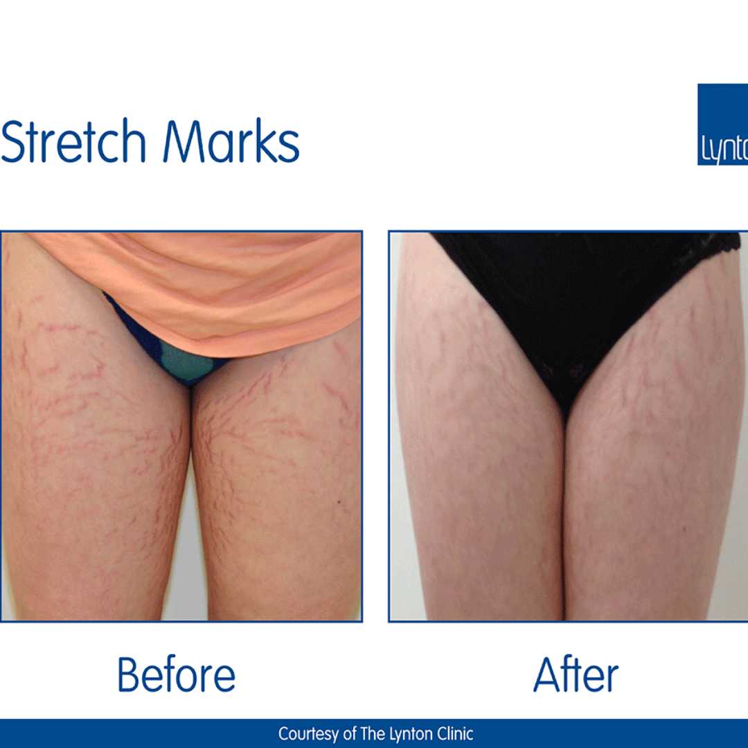 Ciara Stretchmarks Treatment Oil – Fade Stretchmarks on Belly & Thighs – With Fish Collagen – Nourish, Repair & Renew – Deeply Hydrates, Improves Elasticity – Safe for Sensitive Skin