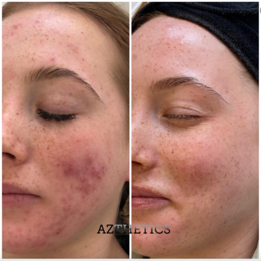 The Element Acne Relief Serum – Clear Acne, Control Oil & Reveal Clearer Skin – Triple Action Acne Defense – Fights Acne, Controls Oil, Minimizes Pores, Fades Marks