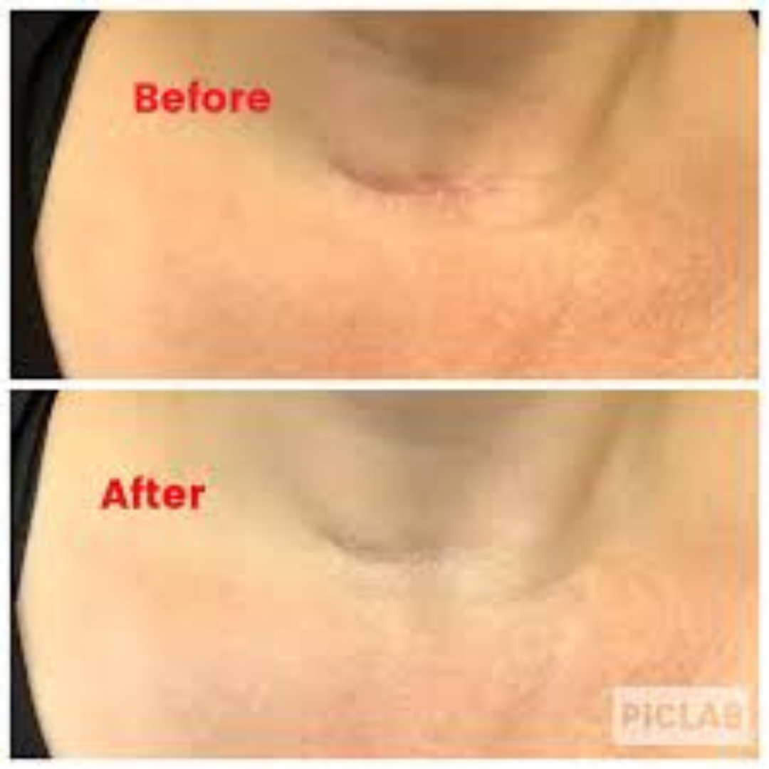 Prequel Scar Solutions Silicone Scar Stick | 60% Silicone + Onion Bulb Ferment + Centella Asiatica | Reduces Scar Thickness, Redness & Improves Texture