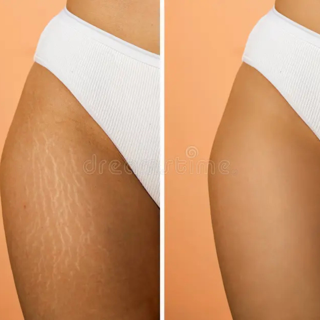 Ciara Stretchmarks Treatment Oil – Fade Stretchmarks on Belly & Thighs – With Fish Collagen – Nourish, Repair & Renew – Deeply Hydrates, Improves Elasticity – Safe for Sensitive Skin
