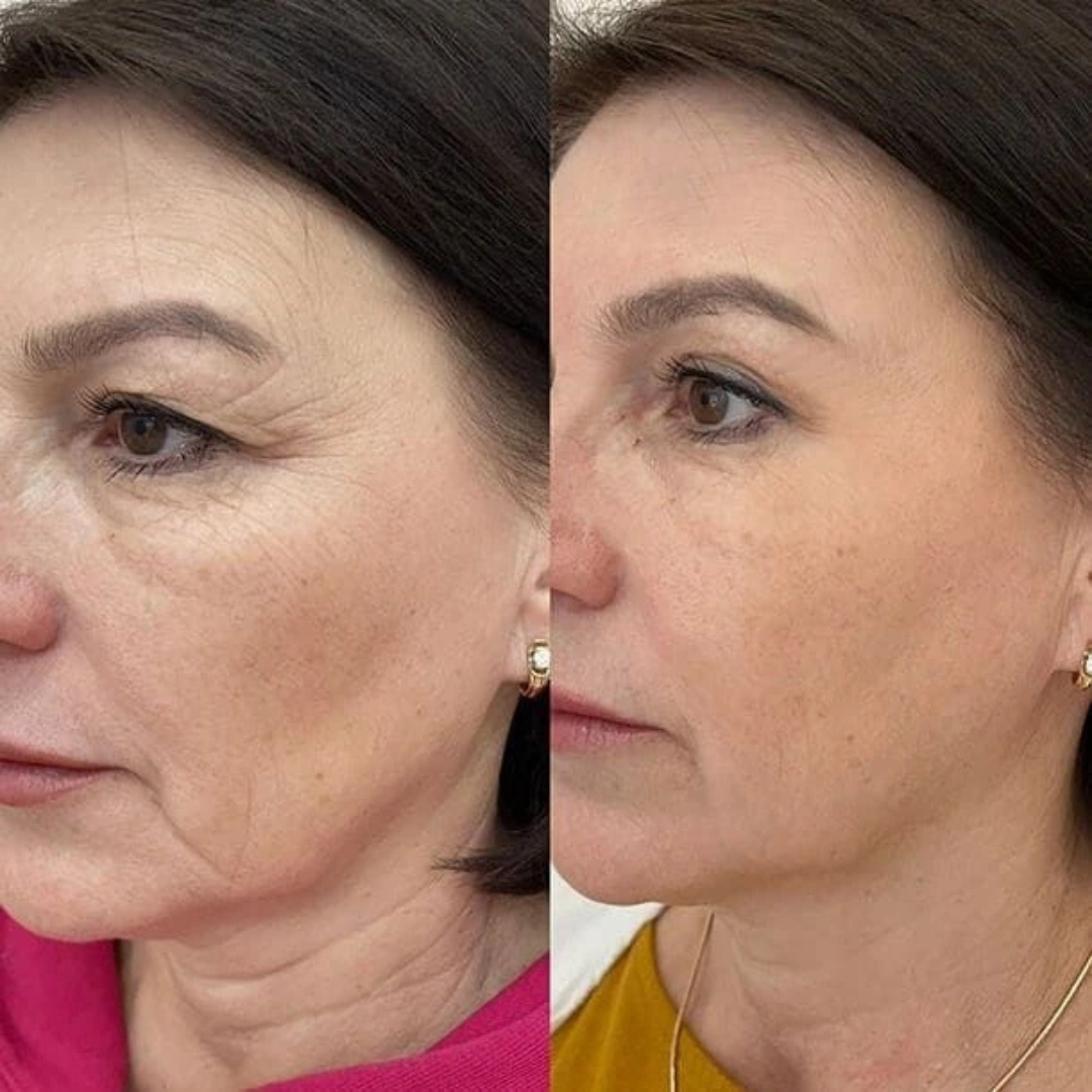 Prequel Scar Solutions Silicone Scar Stick | 60% Silicone + Onion Bulb Ferment + Centella Asiatica | Reduces Scar Thickness, Redness & Improves Texture