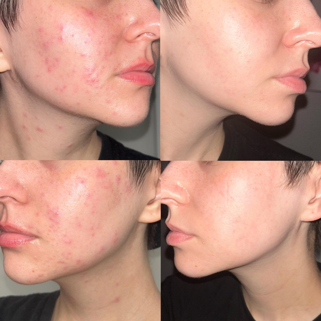 VT Cosmetics Cica Reedle Shot 100 | Micro-Needling Serum with 95,000 Cica Reedles | Smooths Texture, Boosts Absorption & Repairs Skin Barrier
