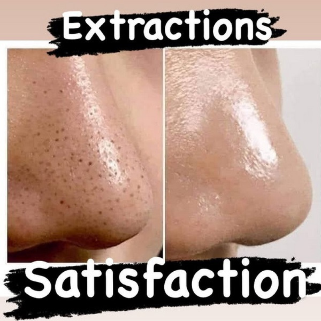The Element Acne Relief Serum – Clear Acne, Control Oil & Reveal Clearer Skin – Triple Action Acne Defense – Fights Acne, Controls Oil, Minimizes Pores, Fades Marks