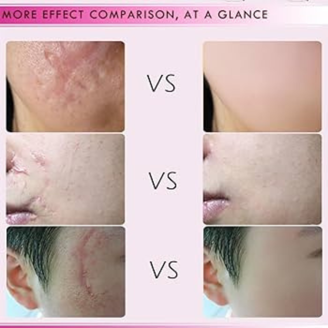 Prequel Scar Solutions Silicone Scar Stick | 60% Silicone + Onion Bulb Ferment + Centella Asiatica | Reduces Scar Thickness, Redness & Improves Texture
