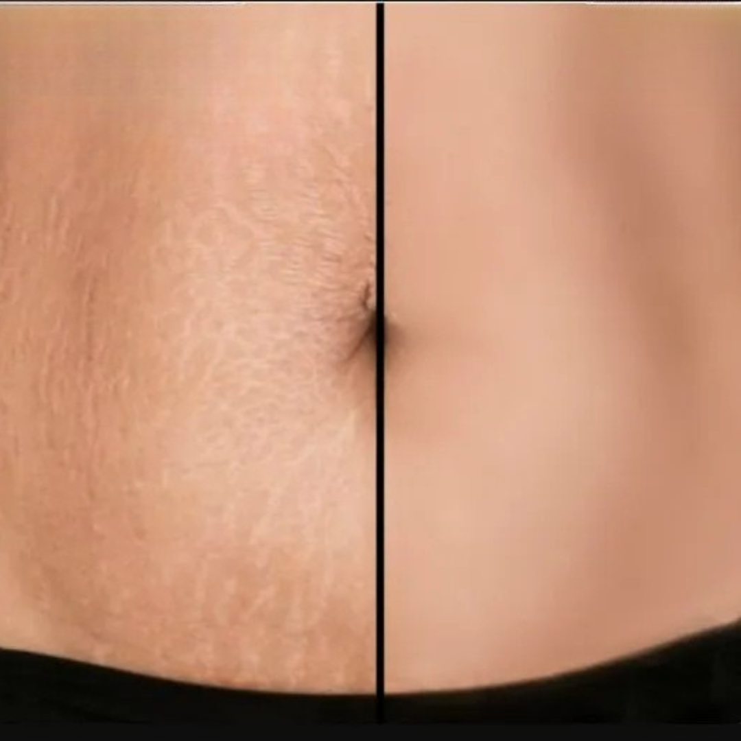 Cryo Thermo Firming Gold Gel – Firms, Tightens & Smooths Cellulite – Fades Stretch Marks – Infused with Nano Gold, Aloe Vera & Witch Hazel – For Thighs, Buttocks, Belly & Arms