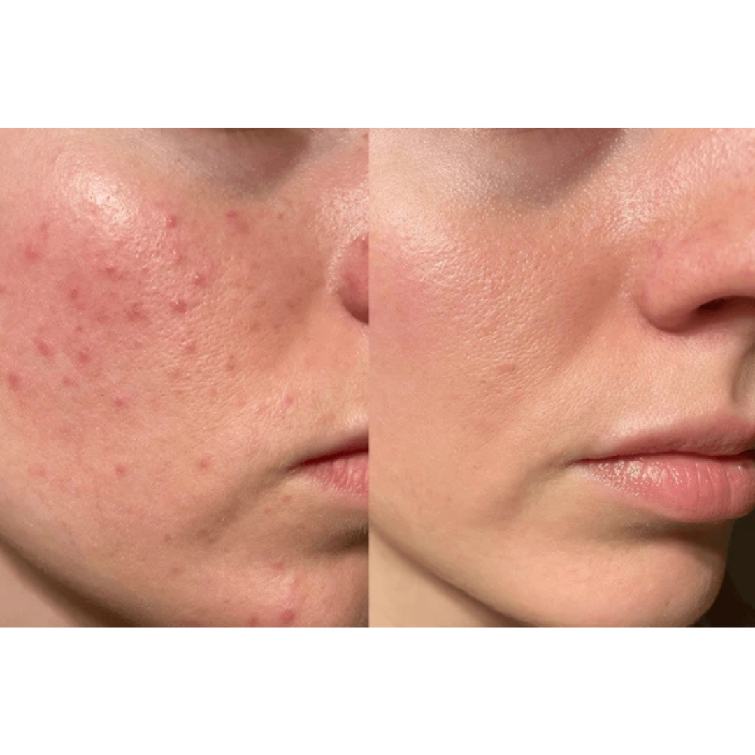 VT Cosmetics Cica Reedle Shot 100 | Micro-Needling Serum with 95,000 Cica Reedles | Smooths Texture, Boosts Absorption & Repairs Skin Barrier