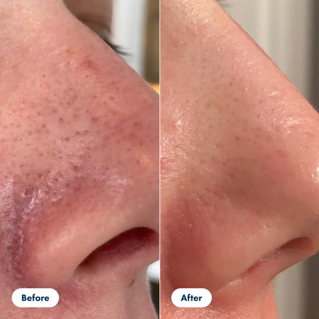 The Element Acne Relief Serum – Clear Acne, Control Oil & Reveal Clearer Skin – Triple Action Acne Defense – Fights Acne, Controls Oil, Minimizes Pores, Fades Marks