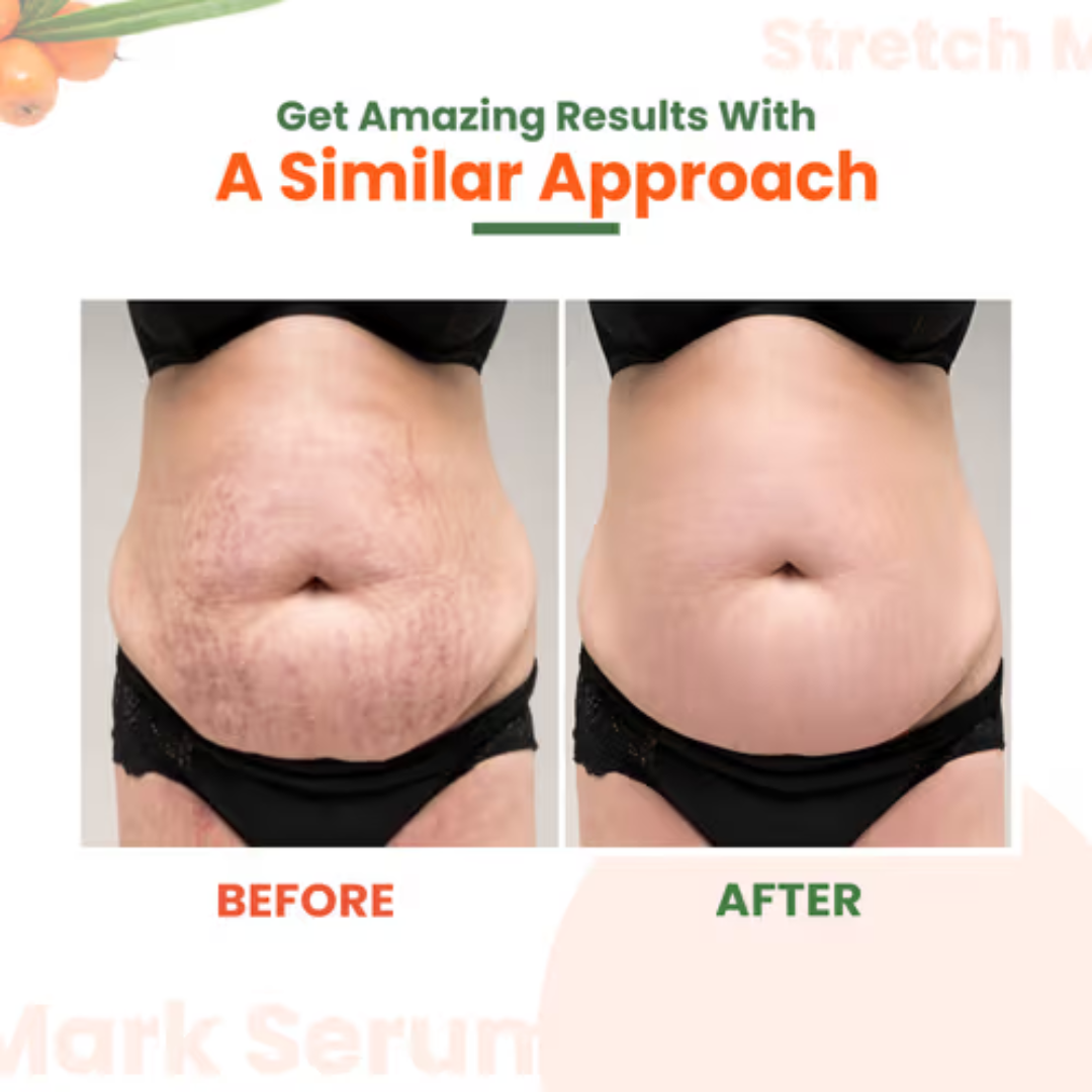 Cryo Thermo Firming Gold Gel – Firms, Tightens & Smooths Cellulite – Fades Stretch Marks – Infused with Nano Gold, Aloe Vera & Witch Hazel – For Thighs, Buttocks, Belly & Arms