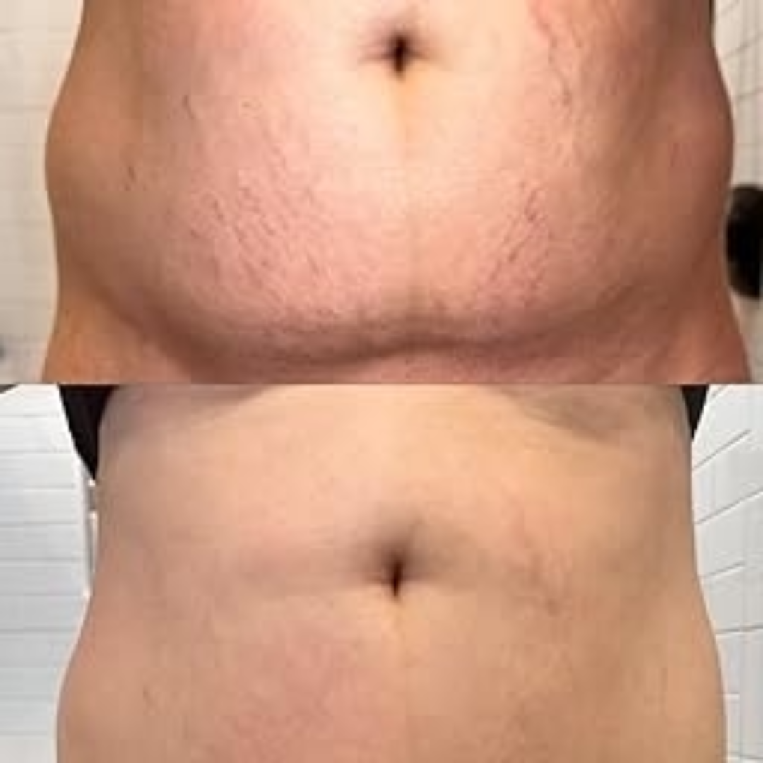 Expressions Wellness Cryo Thermo Firming Gold Gel – Infused with 24K Gold – Firms, Tightens & Transforms Skin – Reduces Stretch Marks, Wrinkles & Cellulite – For Belly, Arms, Thighs & Body Contouring