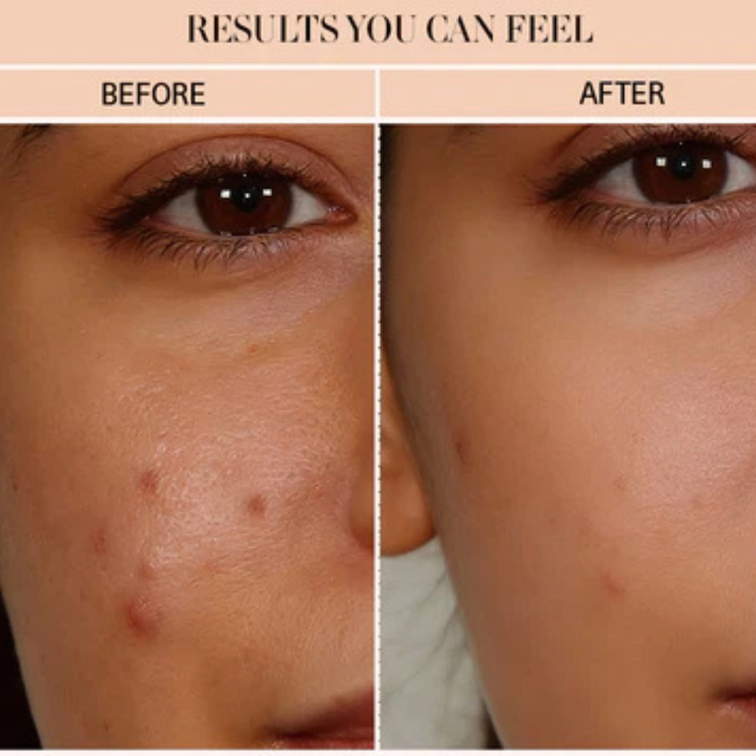 VT Cosmetics Cica Reedle Shot 100 | Micro-Needling Serum with 95,000 Cica Reedles | Smooths Texture, Boosts Absorption & Repairs Skin Barrier