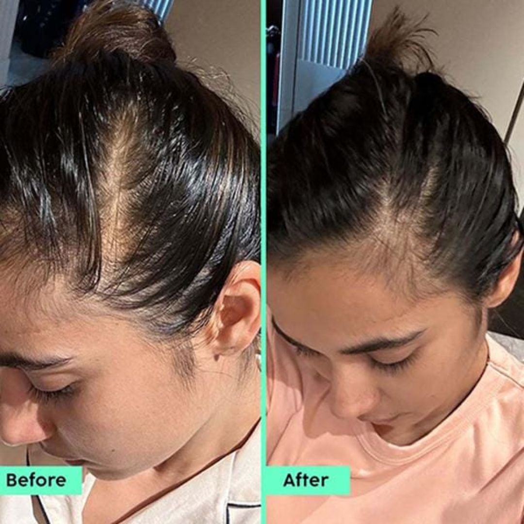 Plix Rosemary Hair Growth Advanced Hair Spray | Redensyl + Aquaxyl + Rosemary Oil | Reduces Hair Fall, Boosts Growth & Strengthens Roots